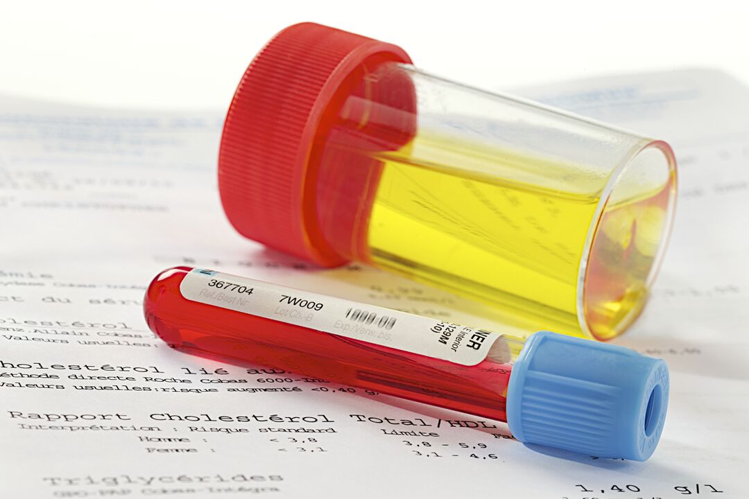 Test krvi a moču pomôže určiť prítomnosť prostatitídy.
