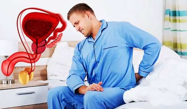 bolesť dolnej časti chrbta v dôsledku prostatitídy