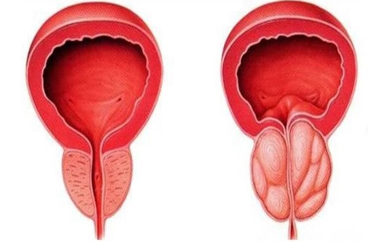 zdravá a zapálená prostata s prostatitídou