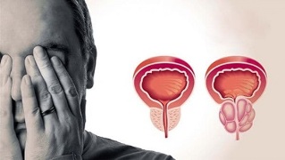 príčiny prostatitídy u mužov