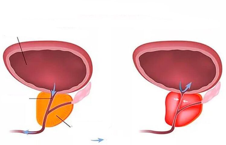 normálna a zapálená prostata