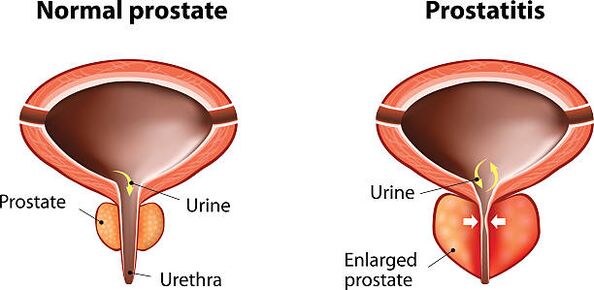normálna a zapálená prostata